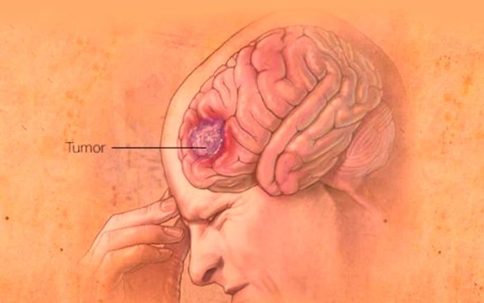 Your Guide to Understanding Etiology, treatment, and prognosis of brain tumors 